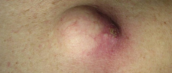 Удаление атером