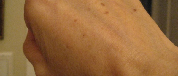 Солодка против пигментных пятен