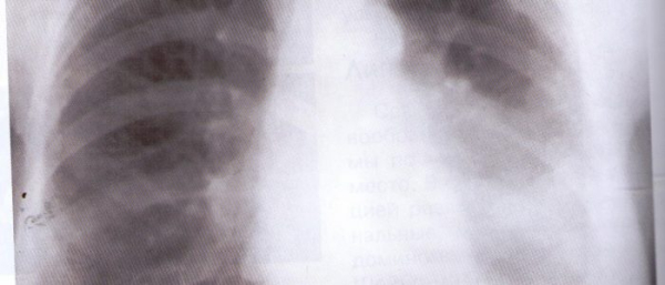 Липоматоз средостения