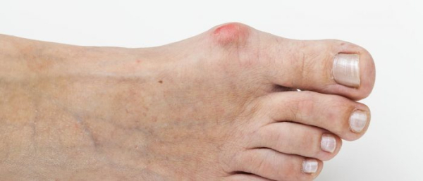 Болезненный нарост на ноге