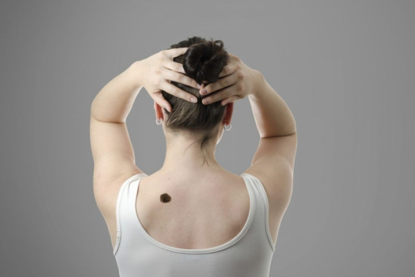 Родинки на спине