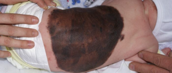 Наследственные невусы