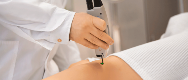 Удаление ангиомы