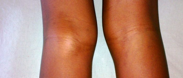 Гигромы подколенной ямки