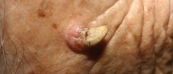 Лечение и удаление кожного рога