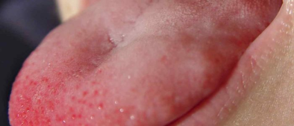 Меланома на слизистой оболочке