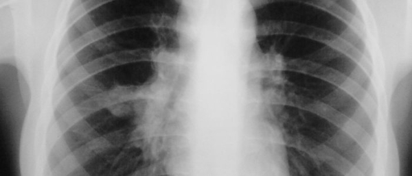 Гемангиома на грудине