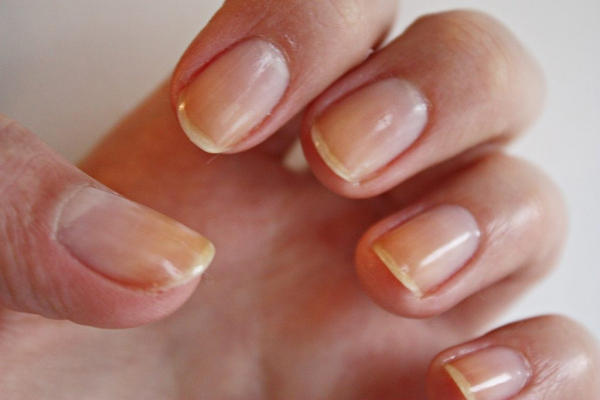 Меланома ногтей