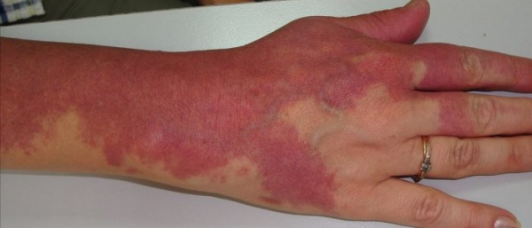 Пламенеющий невус