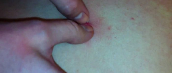 Жировик на попе