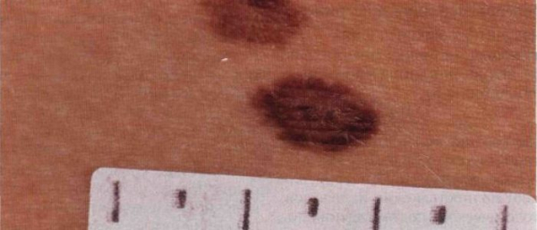 Меланомоопасный невус