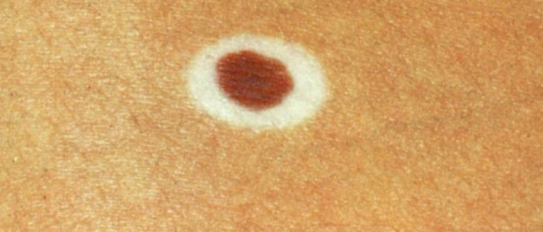 Болезнь Сеттона