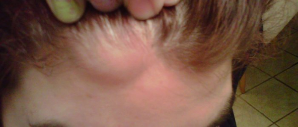 Подкожный жировик