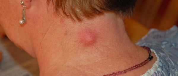 Лечение атеромы в домашних условиях