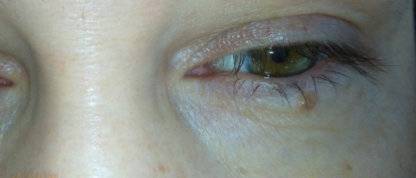 Родинка на реснице