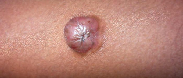 Дерматофибросаркома на теле