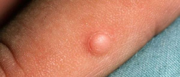 Фиброма на теле