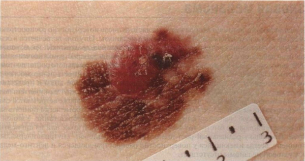 Поверхностная меланома