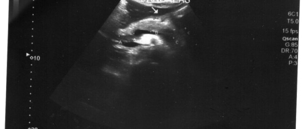 Симптомы и лечение гемангиом селезенки