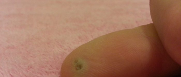 Нужно ли удалять папилломы на теле?