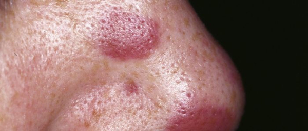 Саркомы капоши