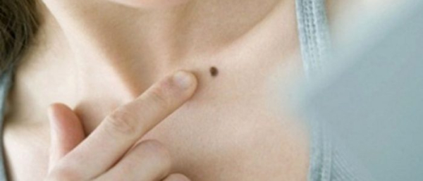 Воспаление родинки