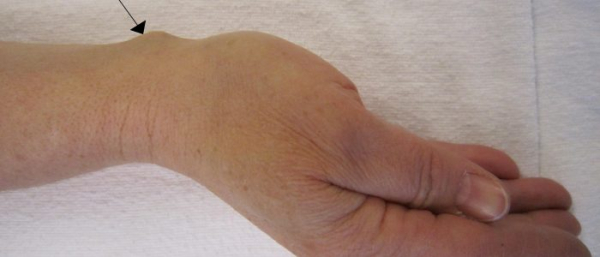 Сухожильная ганглия