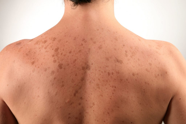 Дерматофибросаркома на теле