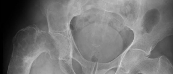 Фибромы яичника