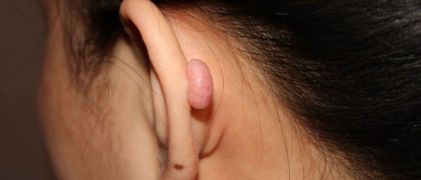 Родинка на ухе