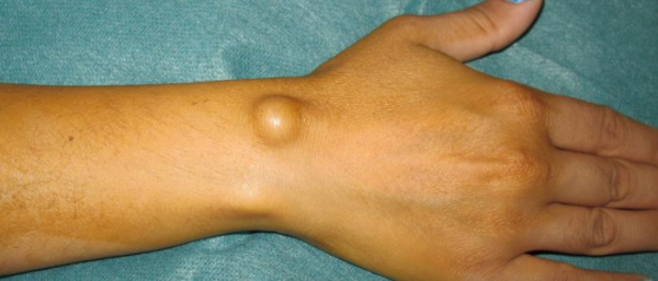 Гигрома на запястье