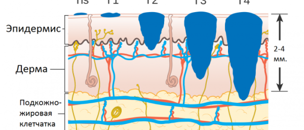Степень меланомы по Кларку