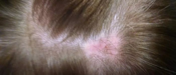 Атерома волосистой части головы