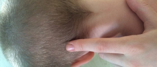 Атерома у ребенка