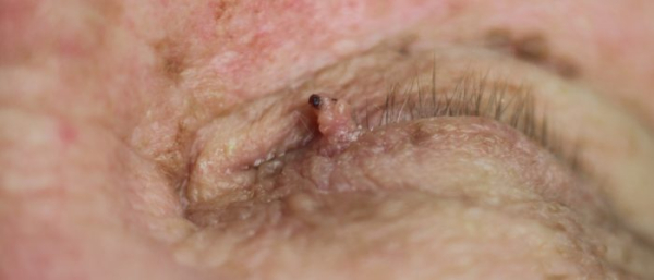 Может ли папиллома исчезнуть сама?