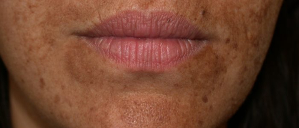 Профилактика и лечение пигментной ксеродермы