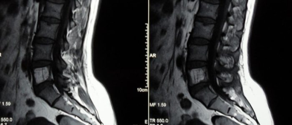Гемангиома позвоночника
