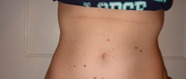 Родинка кровоточит