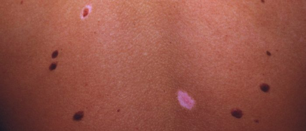 Анемичный невус