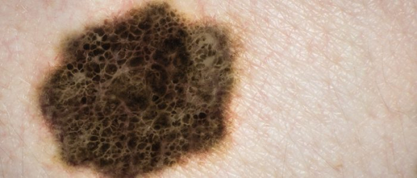 Родинка потемнела