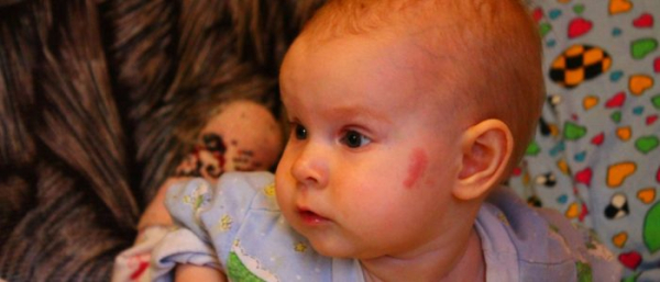 Гемангиома кожи