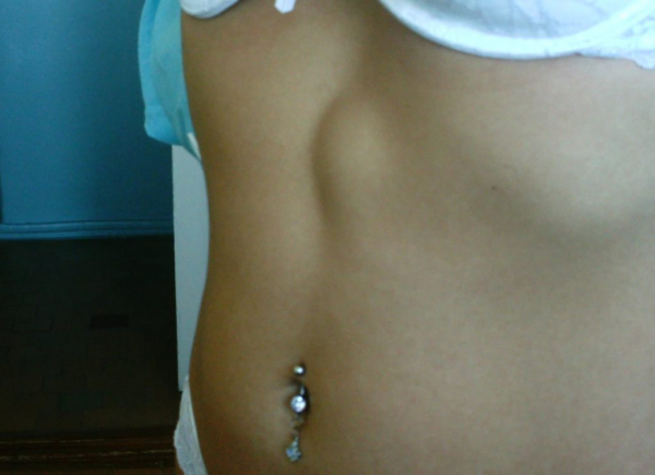 Жировик в паху