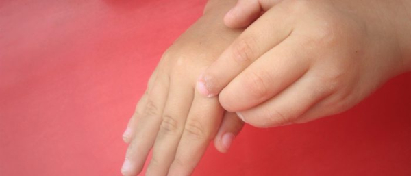 Фиброма руки