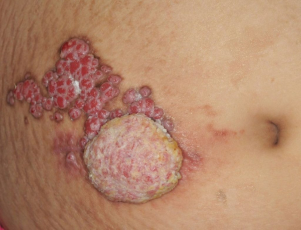 Меланома Дюбрея