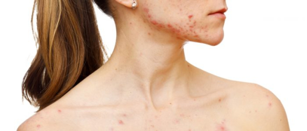 Прыщи и жировики