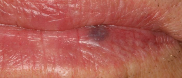 Гемангиома губы