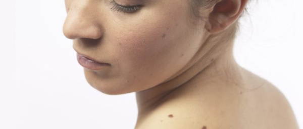 Родинки появляются из-за солнца