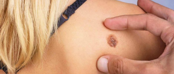 Может ли меланома быть доброкачественной?
