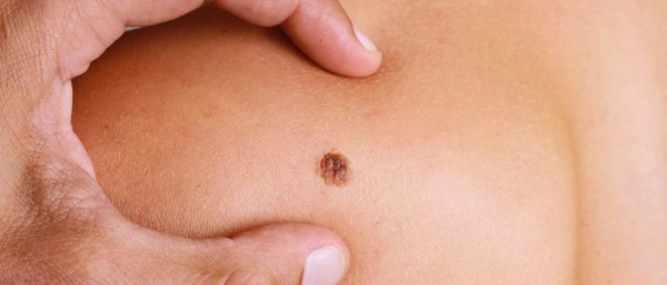 Оторванная родинка