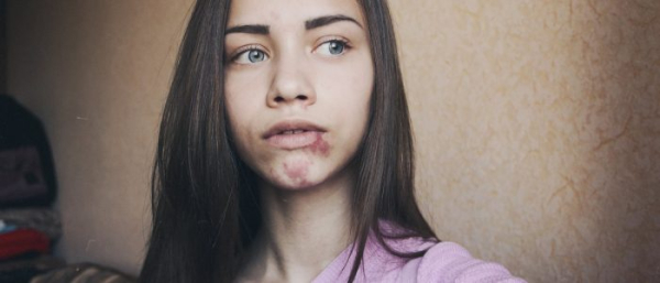 Родимые пятна на лице